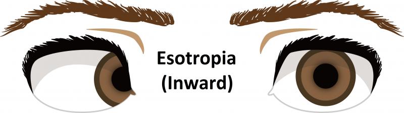 Esotropia (inwards)
