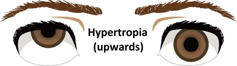 Hypertropia (upwards)